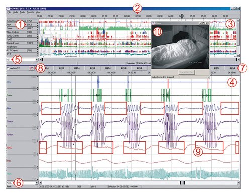 SOMNO® screen Plus e EEG 10-20 Neuroriabilitazione e Robotica